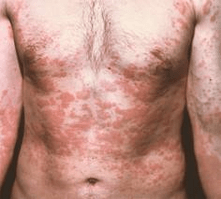 Problematische Haut ist ein Symptom für das Vorhandensein von Parasiten.