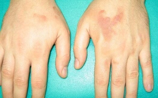 Schmerzen in den Gelenken der Hände können ein Symptom für Parasiten sein.