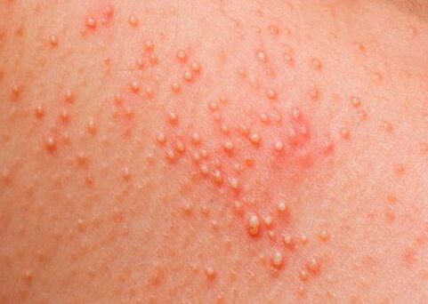 Wird der Körper von Parasiten befallen, tritt eine Hautallergie auf. 