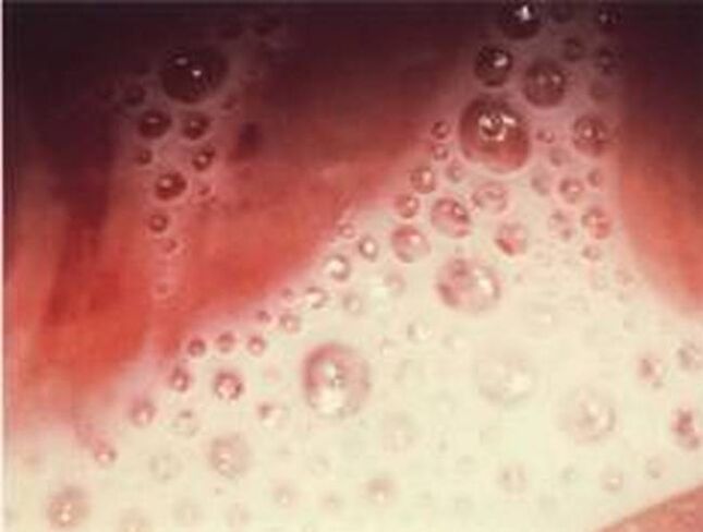 Blasensekretion mit protozoischen Parasiten