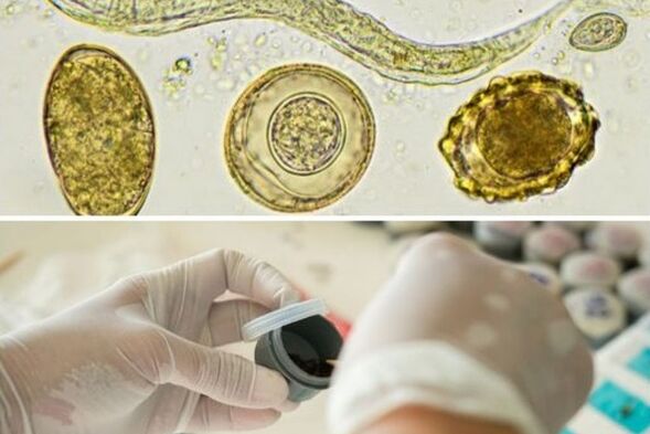 Diagnose des Vorhandenseins von Parasiten im Körper