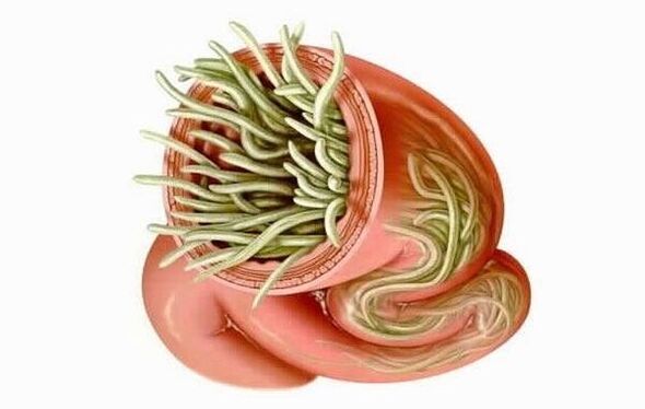 Würmer im menschlichen Darm Foto 1