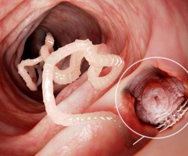 Würmer im menschlichen Darm Foto 2