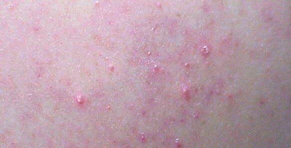 Hautausschläge können ein Zeichen einer Helminthiasis sein. 